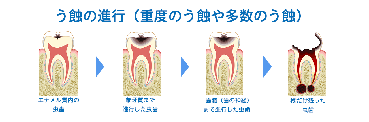 虫歯（重度の虫歯や多数の虫歯）